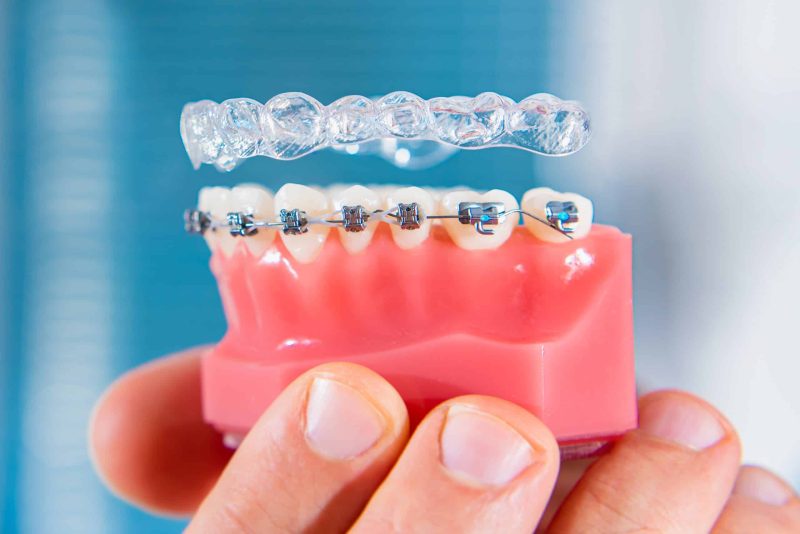 Alternative to Braces Waco