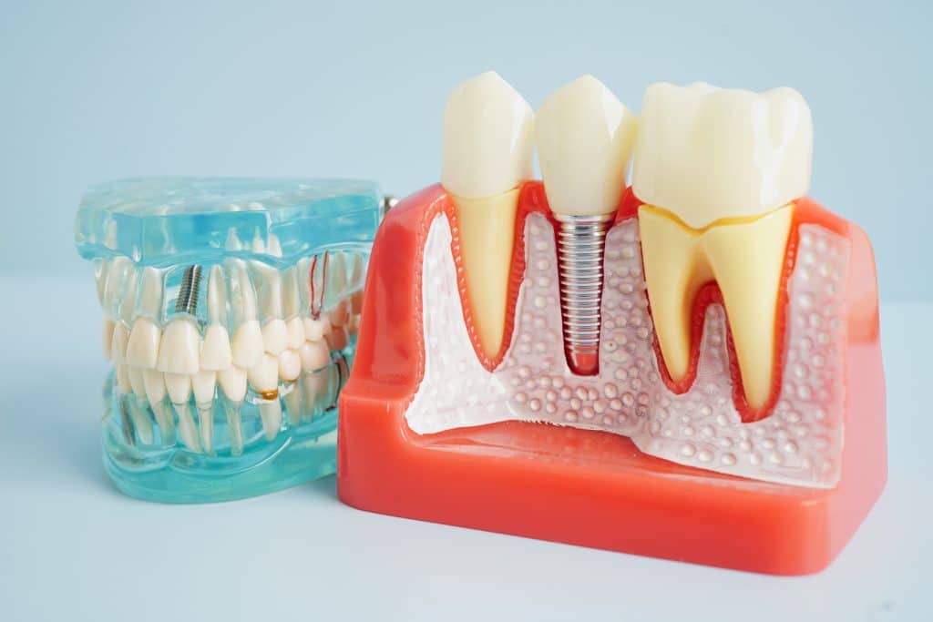 Waco Dental Implants