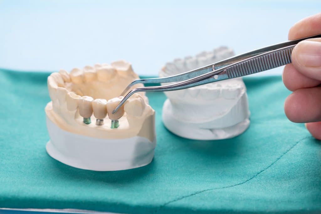 Implant-Supported Dentures Waco