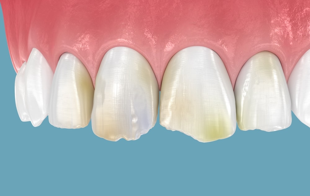 dentist broken teeth